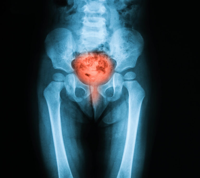 Understanding Bladder Cancer